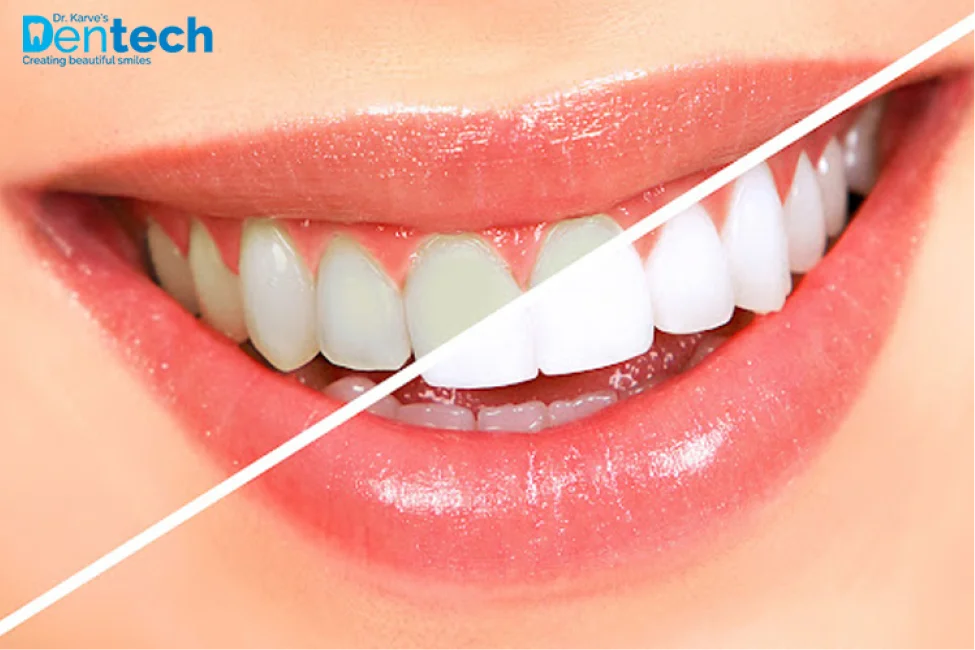 Confused Between Teeth Cleaning and Teeth Whitening